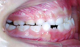 臼歯部交叉咬合