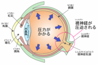 緑内障のメカニズム