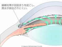 原発開放隅角緑内障
