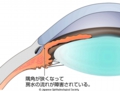 原発閉塞隅角緑内障