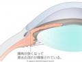 原発閉塞隅角緑内障