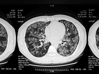 CT thin slice