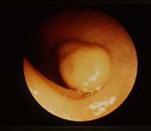 Mucosal Polyp